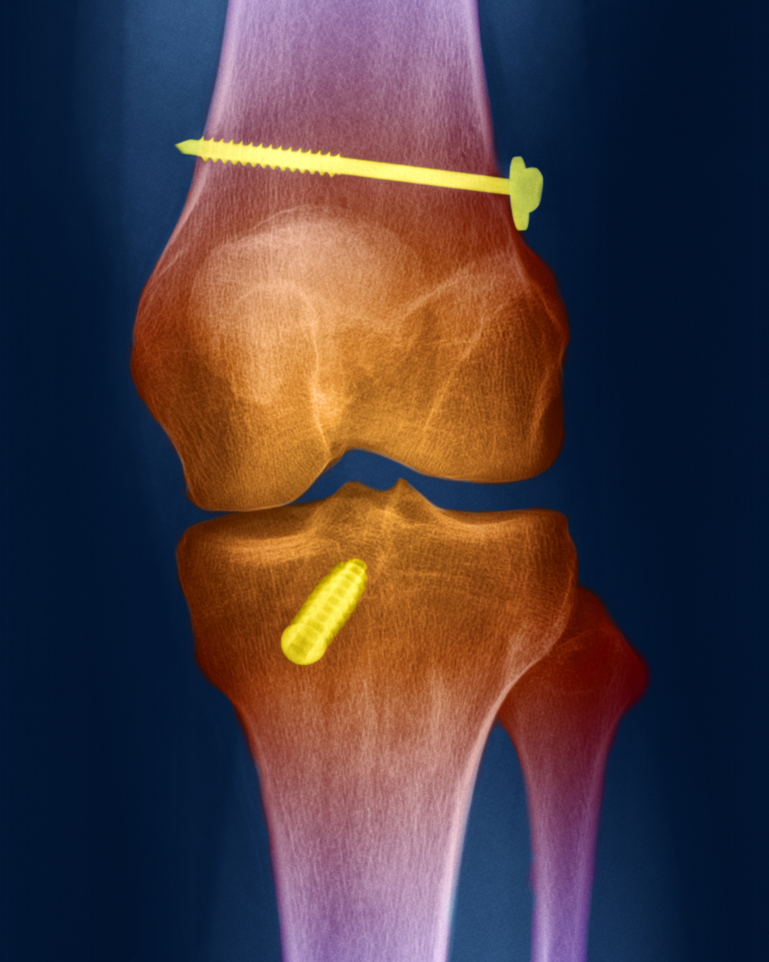 A colorized frontal x-ray view of a knee joint with two screws anchored within bones, one in the femur above the joint and one in the tibia below