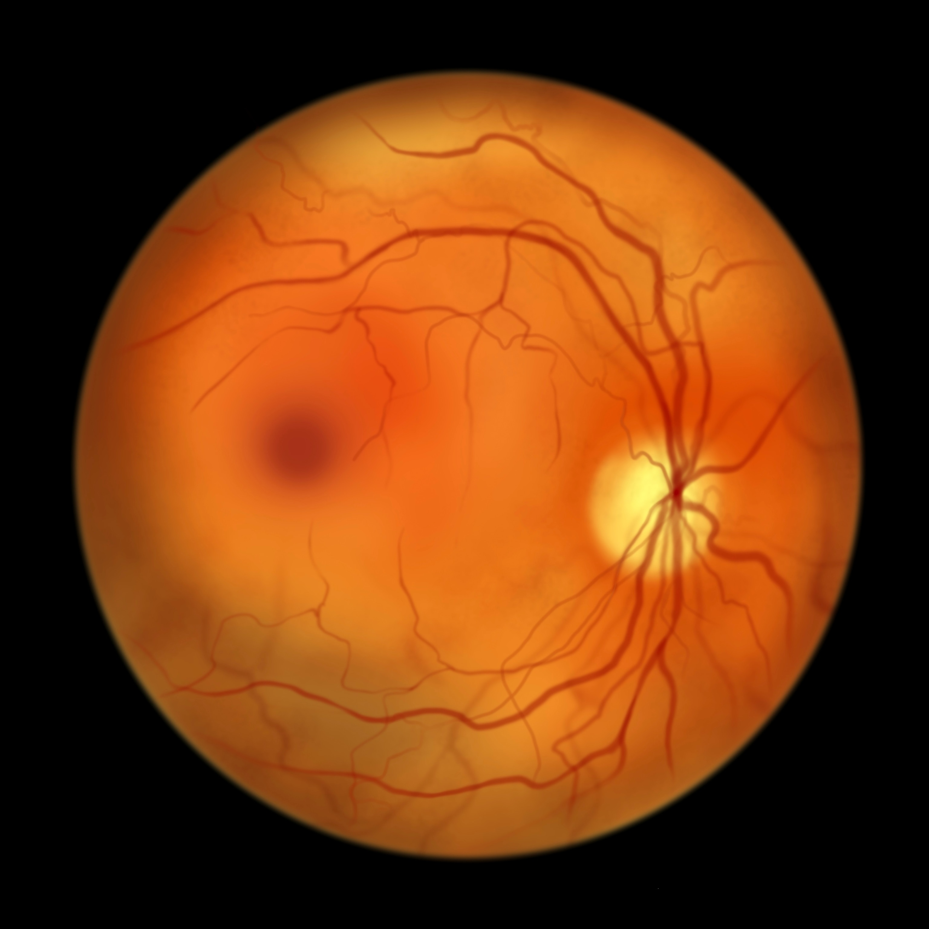 What is retinitis pigmentosa—the vision disorder in the movie Blink?