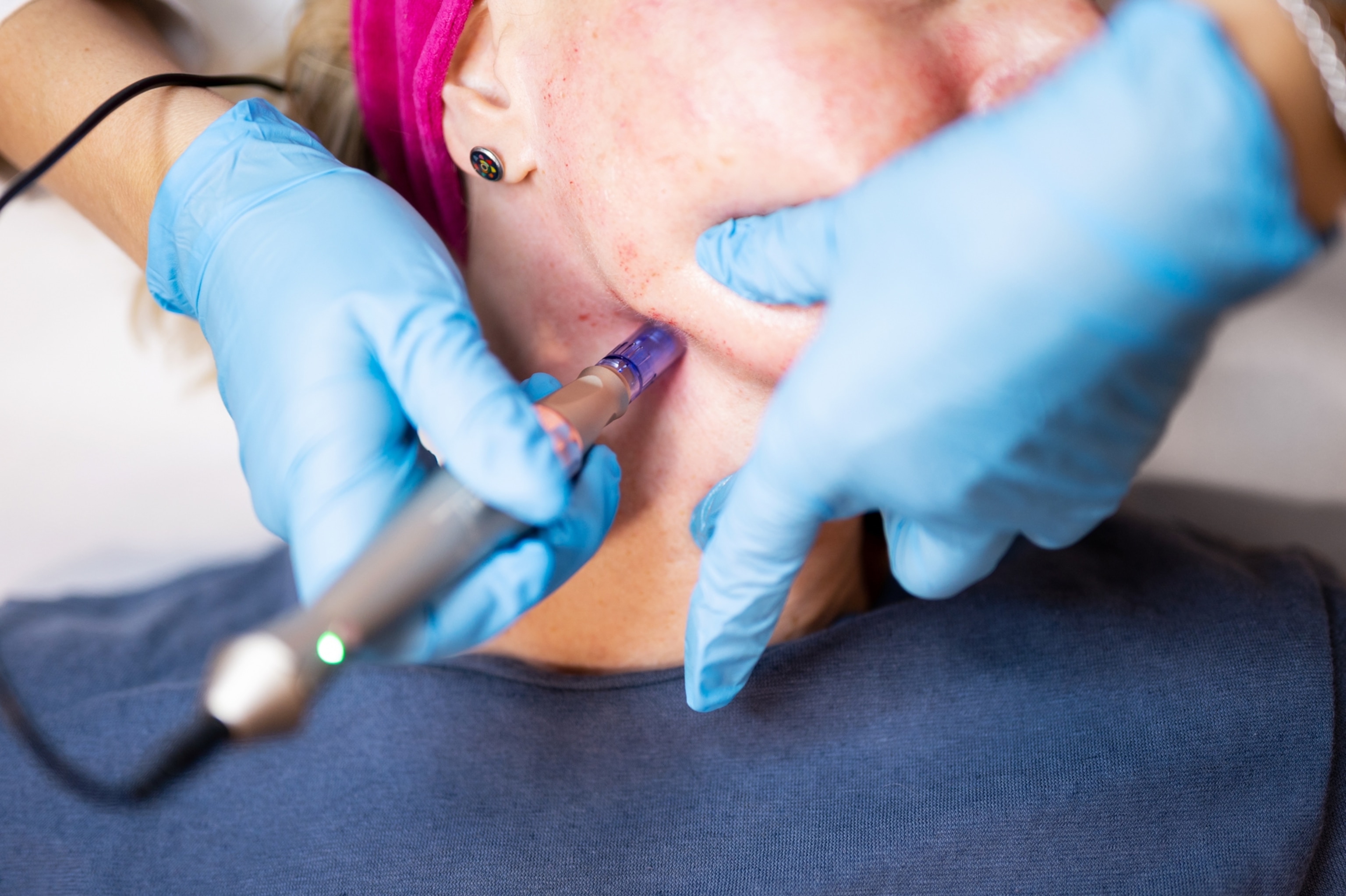 A close-up view of a the gloves hands of an aesthetician as they use a microneedling device on a woman's jawline