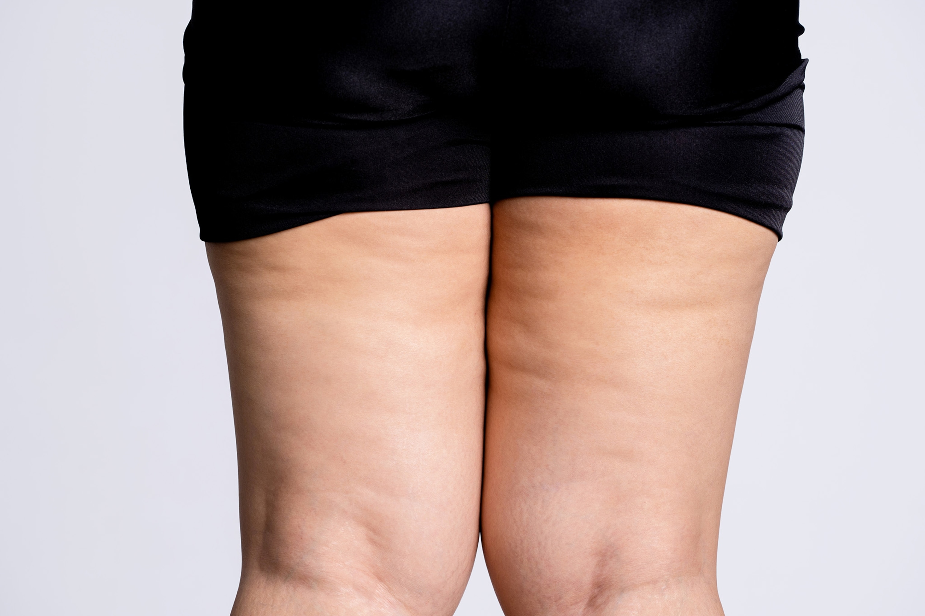 A close-up of the back of a woman's thighs
