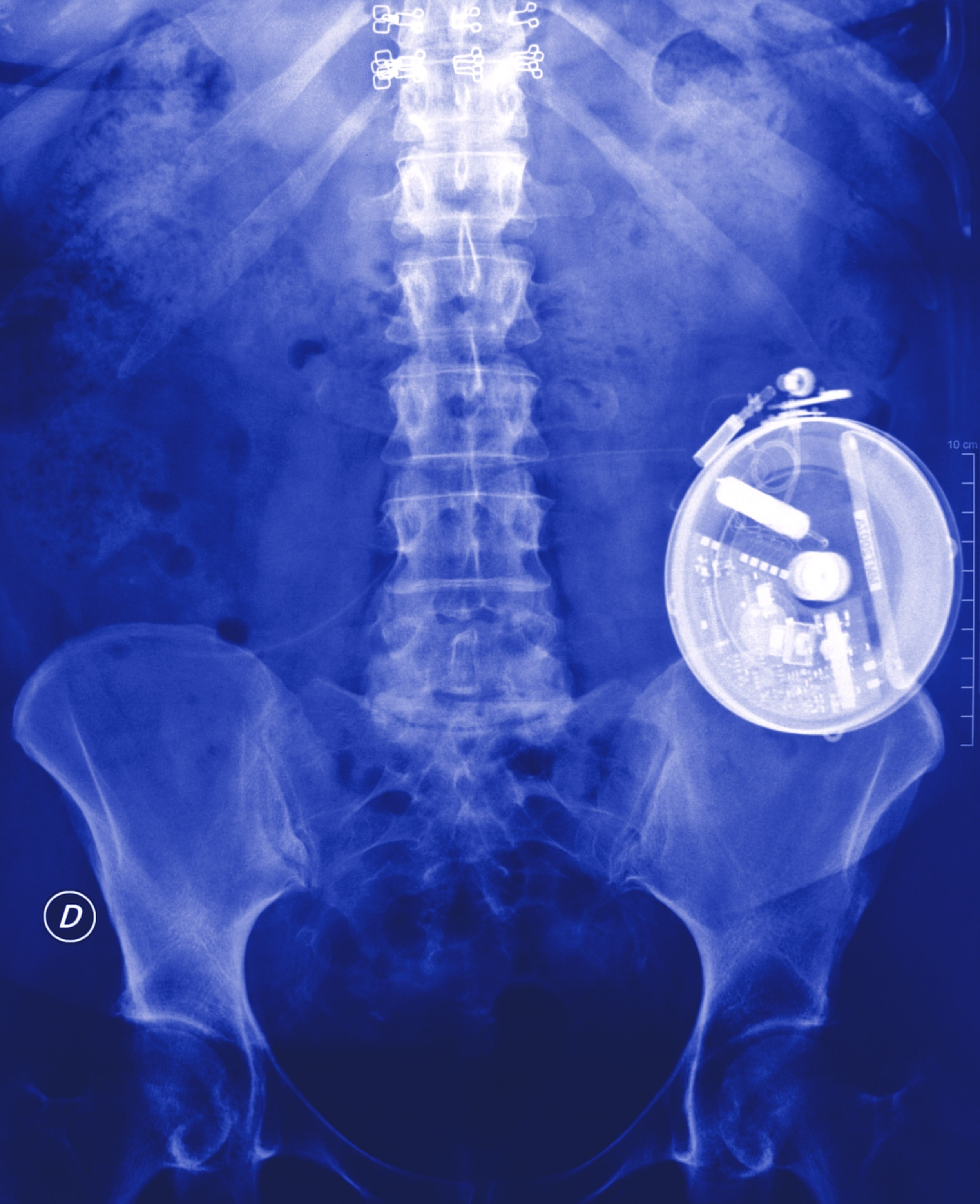 A colorized x-ray of an implanted "artificial pancreas" for the controlled release of insulin in response to blood glucose levels