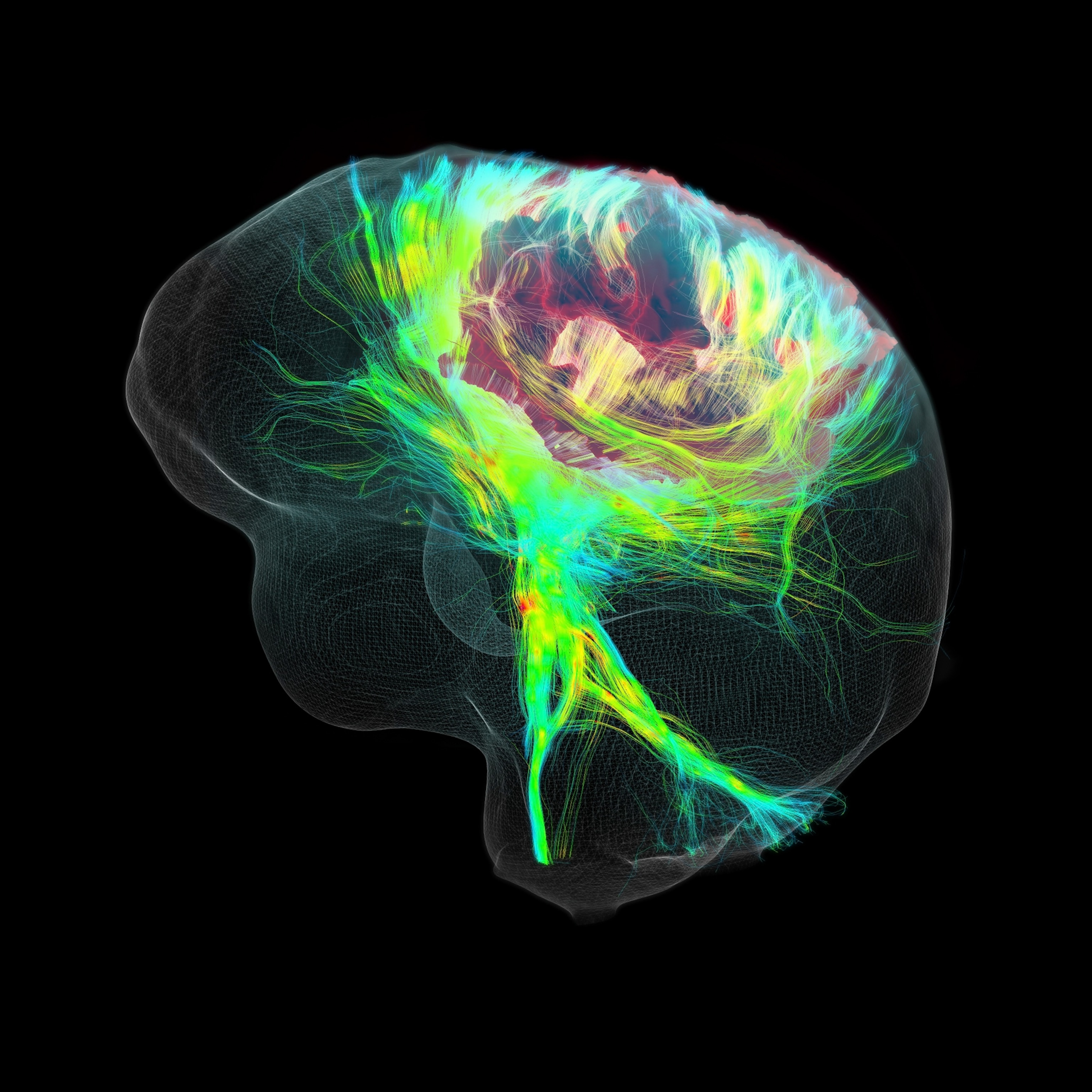 Stopping a tumor's 'cellular looting' may help treatment for brain cancers
